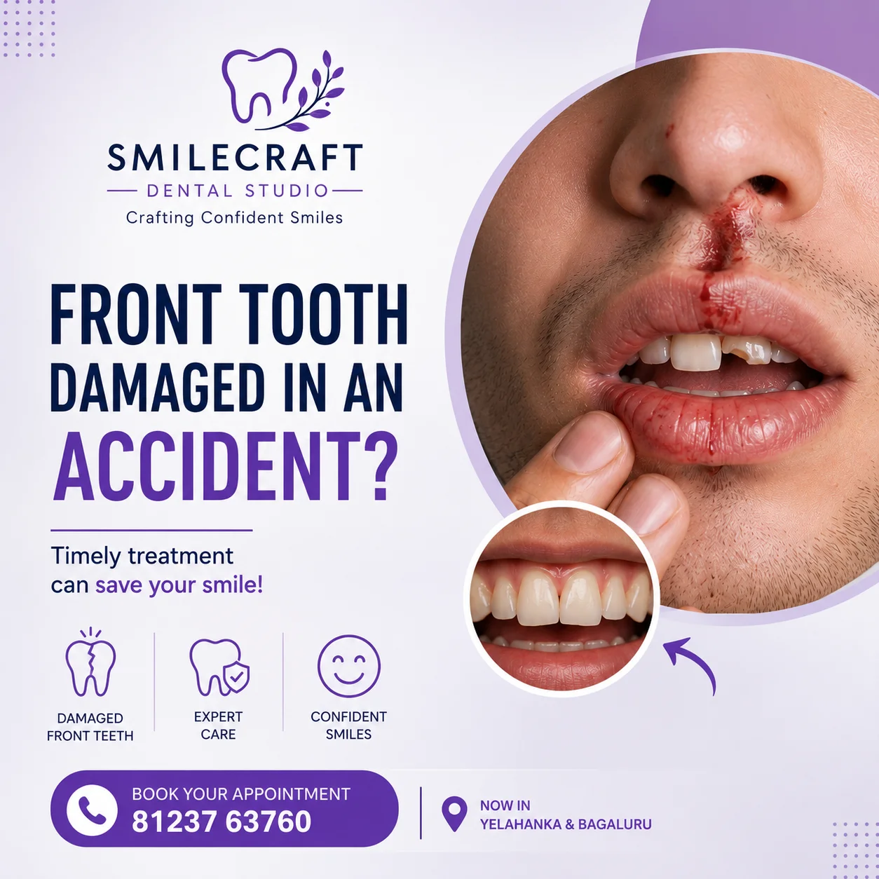 Front Tooth Damaged in an Accident?